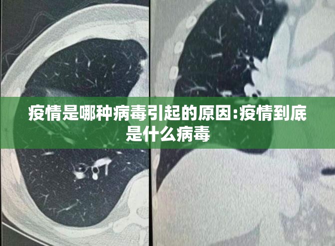 疫情是哪种病毒引起的原因:疫情到底是什么病毒